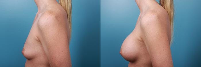 Breast Augmentation Before & After Gallery - Patient 223871 - Image 2