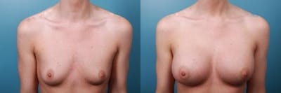 Breast Augmentation Before & After Gallery - Patient 223871 - Image 3