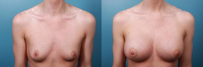Breast Augmentation Before & After Gallery - Patient 223871 - Image 3