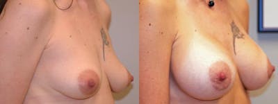 Breast Augmentation Before & After Gallery - Patient 427975 - Image 2