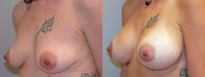 Breast Augmentation Before & After Gallery - Patient 427975 - Image 3