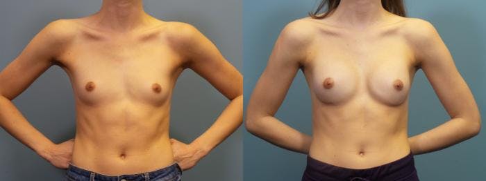 Breast Augmentation Before & After Gallery - Patient 160287 - Image 1