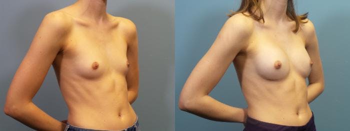 Breast Augmentation Before & After Gallery - Patient 160287 - Image 2