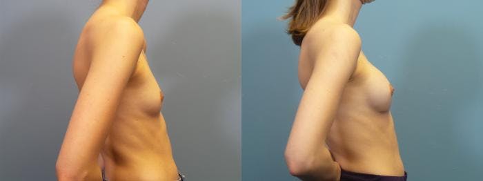 Breast Augmentation Before & After Gallery - Patient 160287 - Image 3