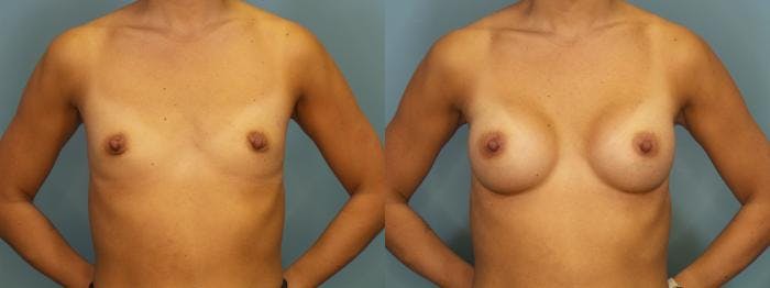 Breast Augmentation Before & After Gallery - Patient 927033 - Image 1