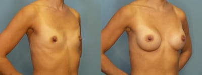 Breast Augmentation Before & After Gallery - Patient 927033 - Image 2