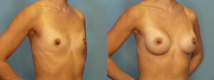 Breast Augmentation Before & After Gallery - Patient 927033 - Image 2