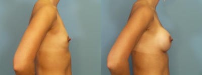 Breast Augmentation Before & After Gallery - Patient 927033 - Image 3