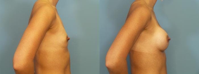 Breast Augmentation Before & After Gallery - Patient 927033 - Image 3