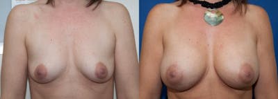 Breast Augmentation Before & After Gallery - Patient 272374 - Image 1