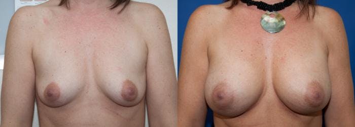 Breast Augmentation Before & After Gallery - Patient 272374 - Image 1