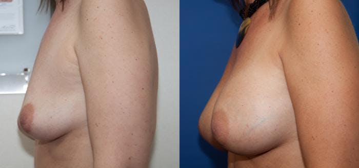 Breast Augmentation Before & After Gallery - Patient 272374 - Image 2