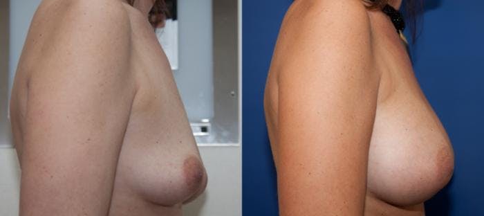 Breast Augmentation Before & After Gallery - Patient 272374 - Image 3