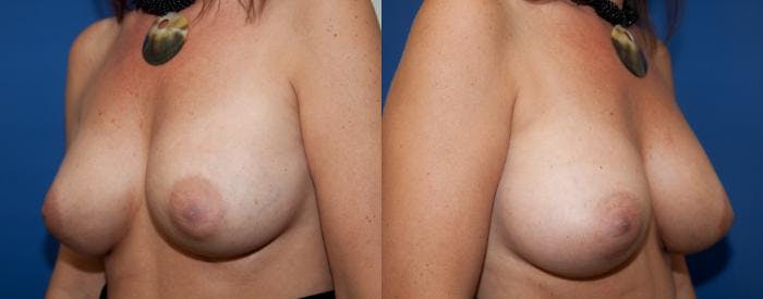 Breast Augmentation Before & After Gallery - Patient 272374 - Image 4