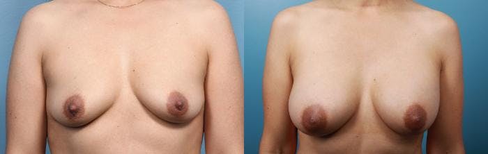 Breast Augmentation Before & After Gallery - Patient 105275 - Image 1