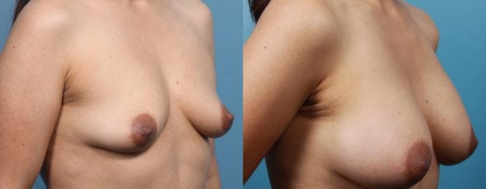 Breast Augmentation Before & After Gallery - Patient 105275 - Image 2