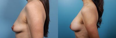 Breast Augmentation Before & After Gallery - Patient 105275 - Image 3