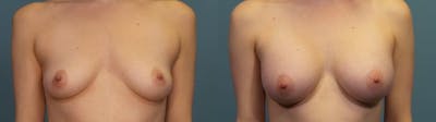Breast Augmentation Before & After Gallery - Patient 158103 - Image 1