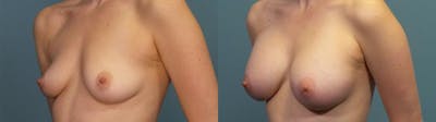 Breast Augmentation Before & After Gallery - Patient 158103 - Image 2