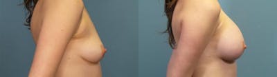 Breast Augmentation Before & After Gallery - Patient 158103 - Image 3