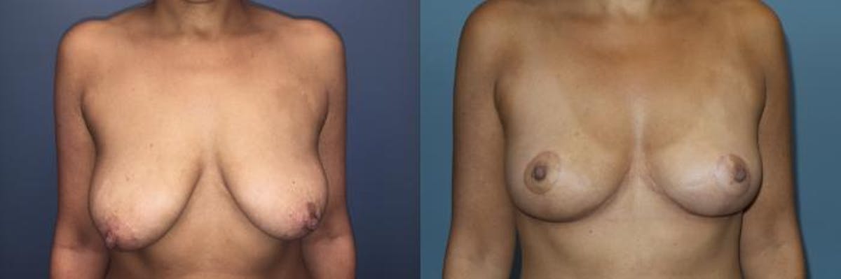 Breast Lift Before & After Gallery - Patient 350103 - Image 1