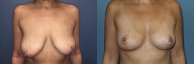 Breast Lift Before & After Gallery - Patient 350103 - Image 1