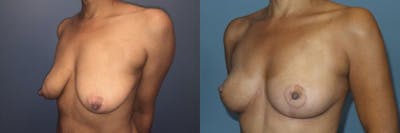 Breast Lift Before & After Gallery - Patient 350103 - Image 2