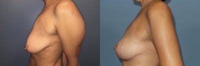 Breast Lift Before & After Gallery - Patient 350103 - Image 3