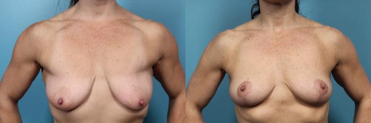 Breast Lift Before & After Gallery - Patient 126511 - Image 1