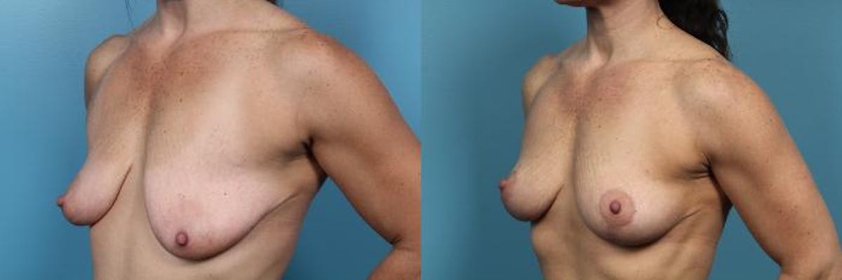 Breast Lift Before & After Gallery - Patient 126511 - Image 2