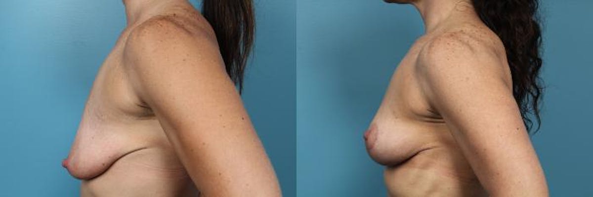 Breast Lift Before & After Gallery - Patient 126511 - Image 3