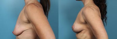 Breast Lift Before & After Gallery - Patient 126511 - Image 3