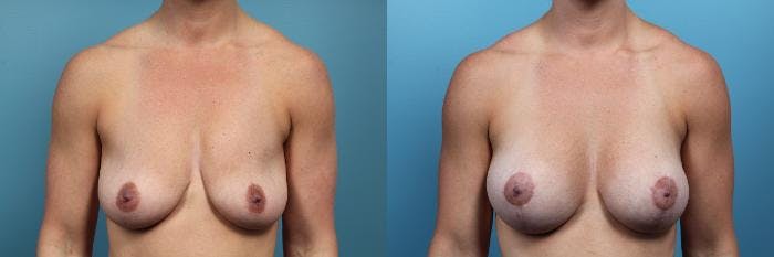 Breast Lift Before & After Gallery - Patient 940374 - Image 1