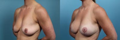 Breast Lift Before & After Gallery - Patient 940374 - Image 2