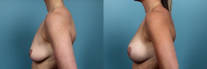 Breast Lift Before & After Gallery - Patient 940374 - Image 3