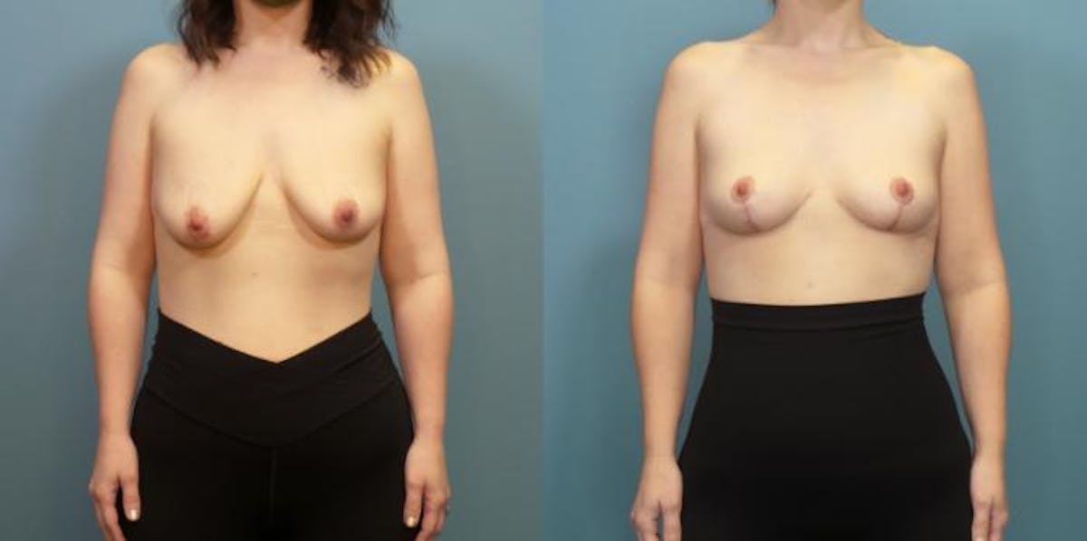 Breast Lift Before & After Gallery - Patient 148693 - Image 1