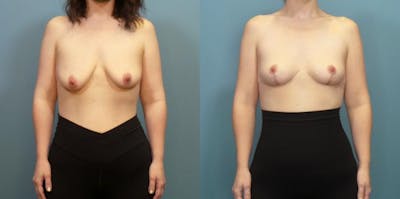 Breast Lift Before & After Gallery - Patient 148693 - Image 1