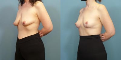 Breast Lift Before & After Gallery - Patient 148693 - Image 2