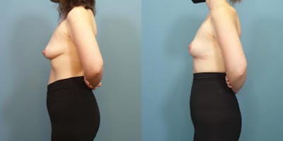 Breast Lift Before & After Gallery - Patient 148693 - Image 3