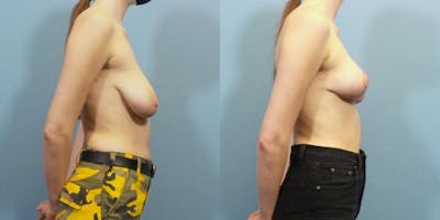 Breast Lift Before & After Gallery - Patient 419832 - Image 3