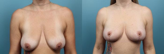 Breast Lift Before & After Gallery - Patient 971754 - Image 1