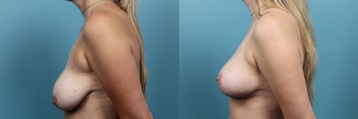 Breast Lift Before & After Gallery - Patient 971754 - Image 3