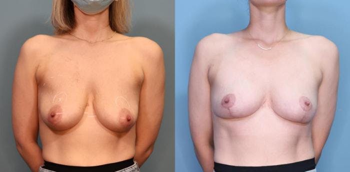 Breast Lift Before & After Gallery - Patient 270941 - Image 1
