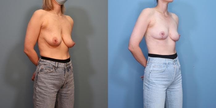 Breast Lift Before & After Gallery - Patient 270941 - Image 2