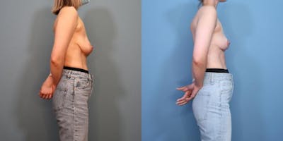 Breast Lift Before & After Gallery - Patient 270941 - Image 3