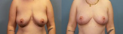 Breast Lift Before & After Gallery - Patient 391386 - Image 1
