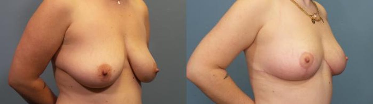 Breast Lift Before & After Gallery - Patient 391386 - Image 2