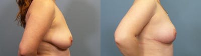 Breast Lift Before & After Gallery - Patient 391386 - Image 3