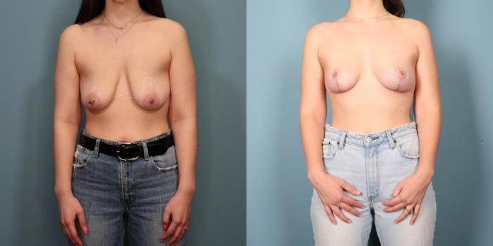 Breast Lift Before & After Gallery - Patient 308464 - Image 1