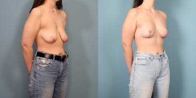 Breast Lift Before & After Gallery - Patient 308464 - Image 2